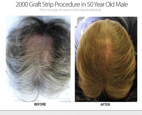 2000 Graft Strip Surgery Crown Restoration Dr Robert Jones