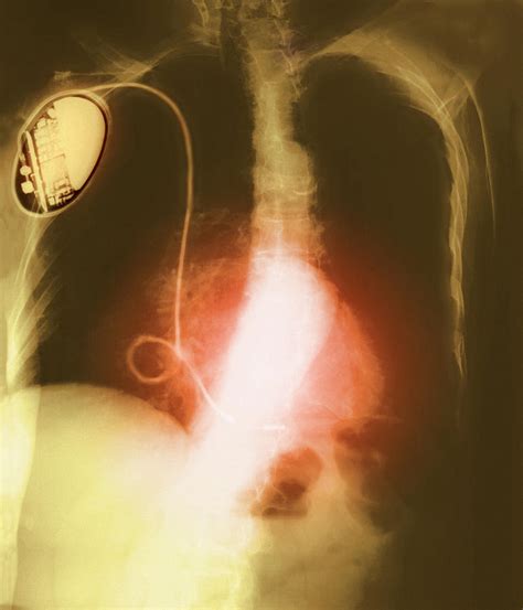 Coloured Chest X Ray Showing Heart Pacemaker Photograph By Mehau Kulyk