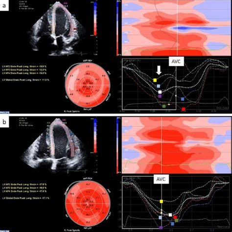 Figure A Two Dimensional Speckle Tracking Echocardiography D Ste