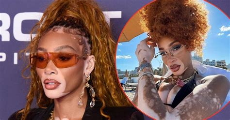 Winnie Harlow Sizzles In Tiny Bikini As She Lounges At The Beach