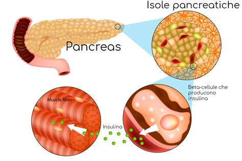 Insulinoma Cause Sintomi Pericoli E Cura