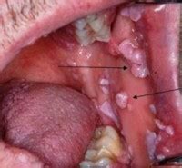 Ağızda Siğil Tedavisi Ağızda Siğil beliritleri Oral HPV Kondilom