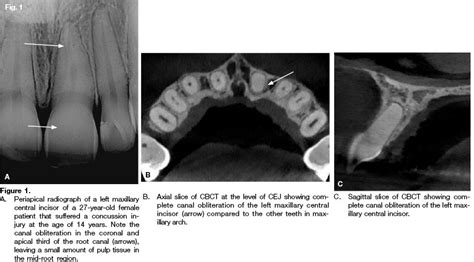 Calcific Metamorphosis A Review Of Literature And Clinical Management