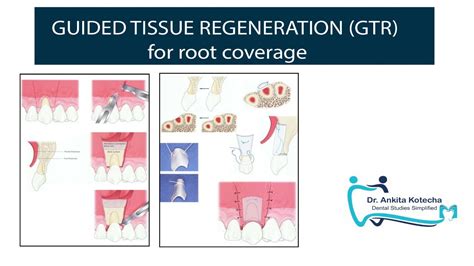 GUIDED TISSUE REGENERATION GTR For Root Coverage ADDITIVE TREATMENTS