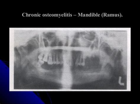 Osteomyelitis