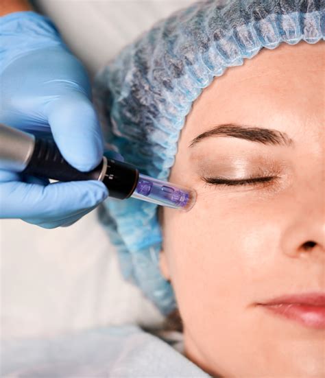 Formation Microneedling Odyssée Santé Et Beauté