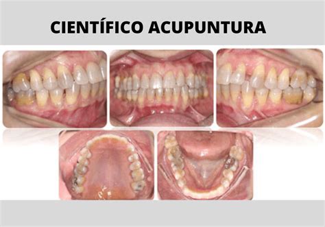 Acupuntura No Controle Dos Sinais E Sintomas Do Bruxismo Relato De