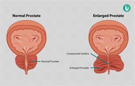 Benign Prostatic Hyperplasia Bph Signs And Symptoms 46 Off