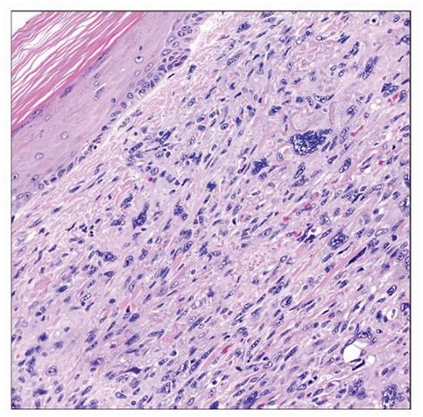 Dermatofibrosarcoma Pathology Outlines