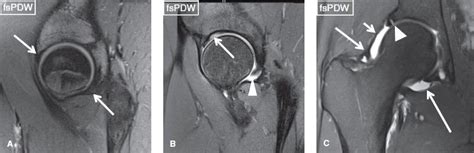 Iliofemoral Ligament Mri