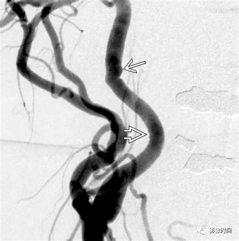 颈动脉间隙解剖与其常见的 12 种疾病影像表现 丁香园