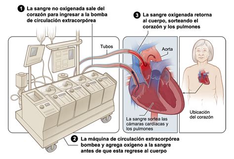 Cirugía cardíaca Qué esperar durante la cirugía NHLBI NIH