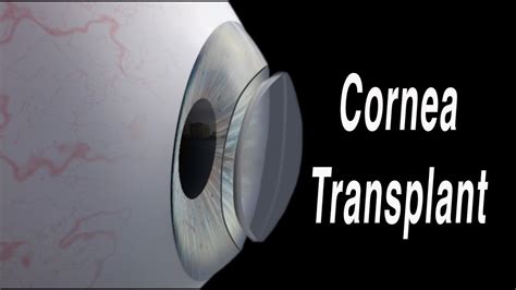 Cornea Transplant Penetrating Keratoplasty Youtube