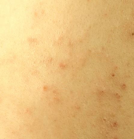 Dermatitis Herpetiformis - Photos, Symptoms, Causes, Treatment