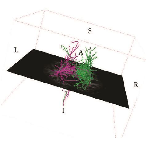 DTI fiber tracking imaging showing fiber tracts indicating stronger ...