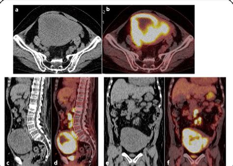 F Fdg Pet Ct A B Axial Ct And Fusion Image C D Sagittal Ct And