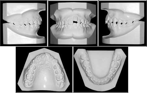 Orthodontic Treatment Of An Ankylosed Maxillary Central Incisor Through Single Tooth Osteotomy