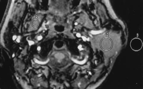 Parotid Masses Prediction Of Malignancy Using Magnetization Transfer