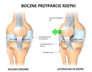 Boczne Przyparcie Rzepki Jakie Objawy Wskazuj Na To Schorzenie