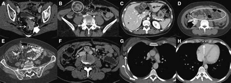 Ct Scan Detection Of Ovarian Cancer Recurrence An Axial Post Contrast