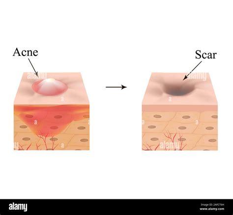 Inflamed acne on the skin. Inflamed pimple. The structure of the skin ...