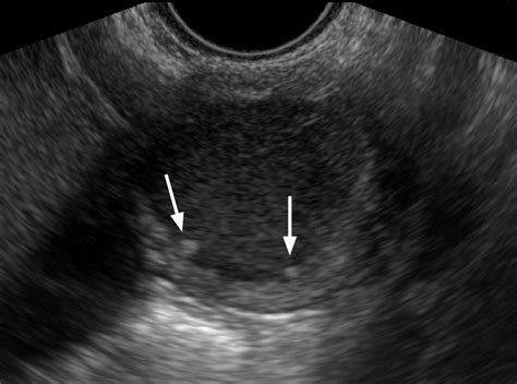 Endometrioid Carcinoma On Background Of Endometriosis In A 44 Year Old