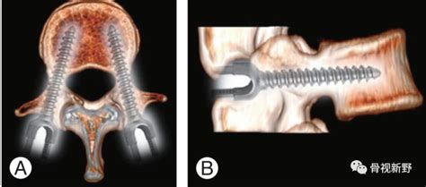 【骨科小技巧】皮质骨轨迹螺钉（cbt）技术！腾讯新闻