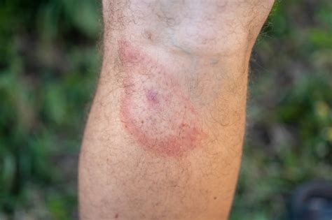 Borreliose Symptome Behandlung And Übertragung Medizin Intersana