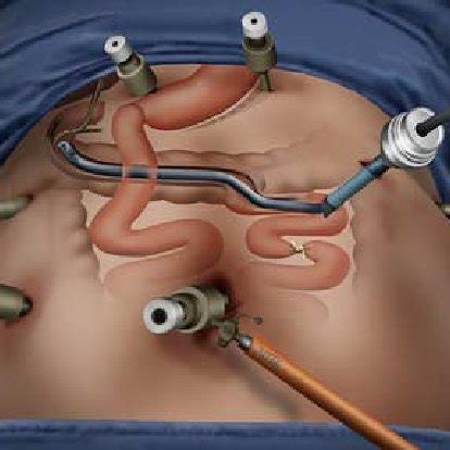 Illustration Showing The Position Of The Trocars The Duodenoscope