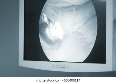 Arthroscopy Surgery Screen Showing Arthroscope Camera Stock Photo ...