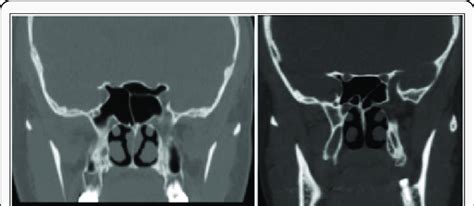 Shows The Sphenoid Sinus Septum Attached To The Optic Nerve A And The