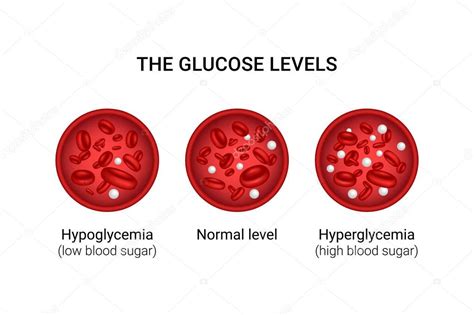 Ilustración Vectorial De Los Niveles De Glucosa En Sangre Hipoglucemia Hiperglucemia 2023