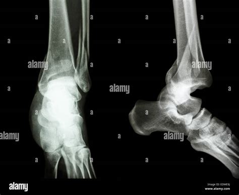 film x-ray ankle AP/Lateral : show fracture distal tibia and fibula Stock Photo: 77392046 - Alamy