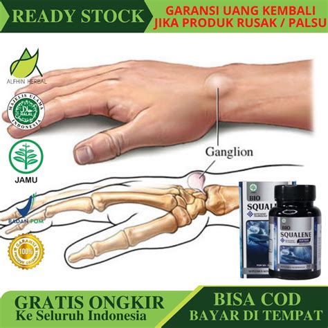 Jual Obat Pengempis Benjolan Kista Ganglion BIO SQUALENE Obat Pengecil