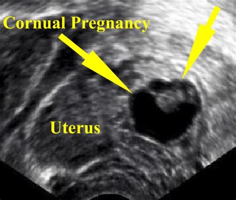 Ultrasonographic Appearance Of Cornual Ectopic Pregnancy Download Scientific Diagram