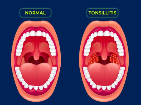 Tonsillitis: Causes, Symptoms, Diagnosis And Treatment - Boldsky.com