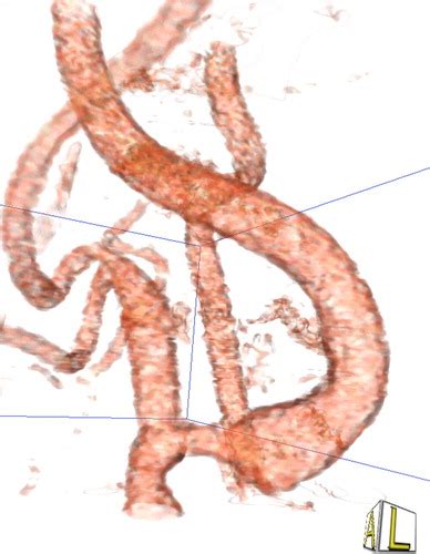 New Techniques In Ct Angiography Radiographics