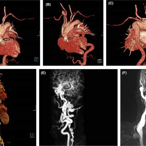 Postoperative 3d‐ct Reconstruction Of The Aorta Download Scientific Diagram