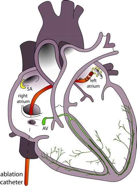 Ablation Procedure Of The Pulmonary Vein Schematic Representation