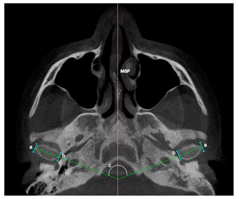 Positional Features Of The Mandibular Condyle In Patients With Facial Asymmetry