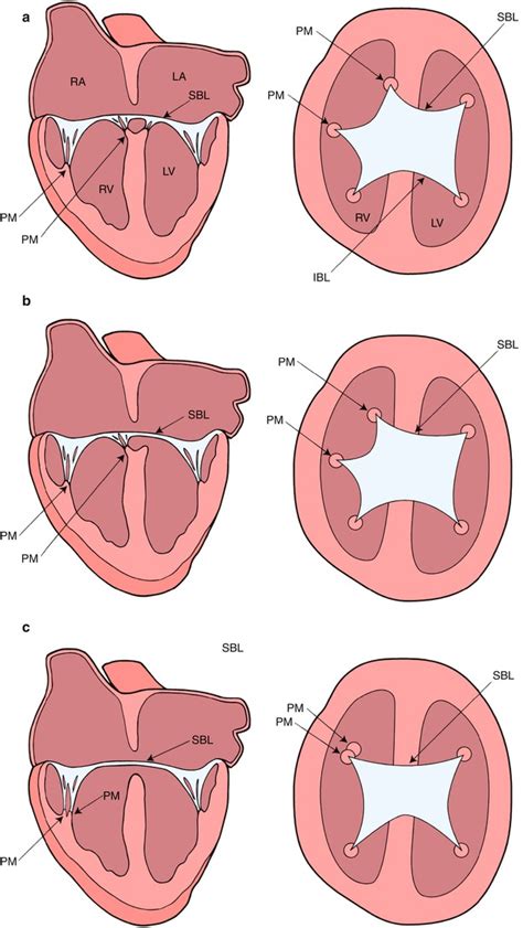 Atrioventricular Septal Defects And Atrioventricular Valve Anomalies