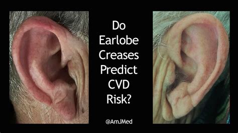 Do Earlobe Creases Predict Heart Disease Risk Youtube