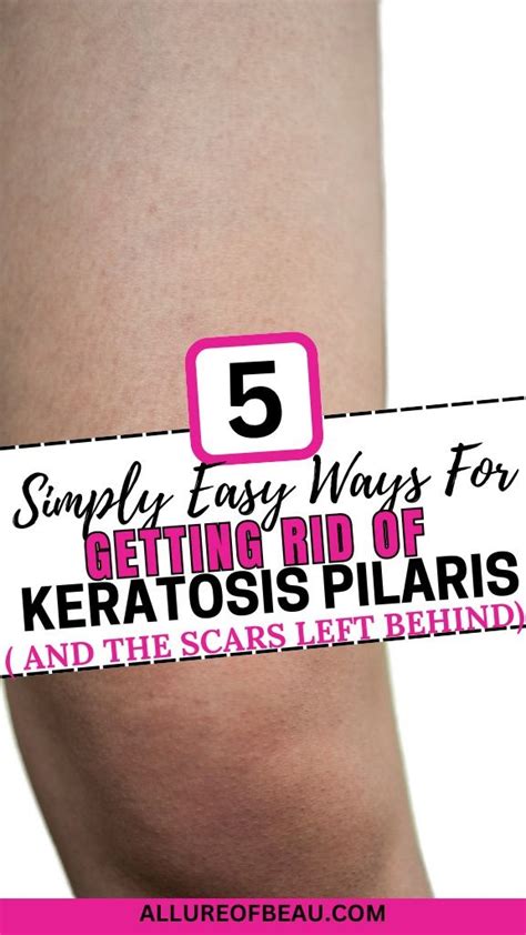 How To Get Rid Of Keratosis Pilaris Artofit