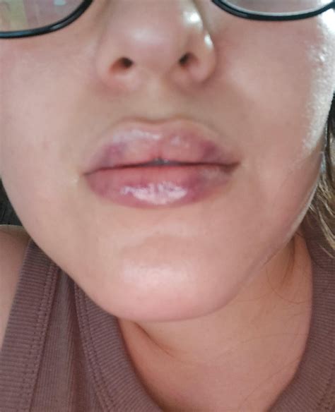 Vascular Occlusion Necrosis Top Lip Discoloration Paleness After Lip Fillers Today Please