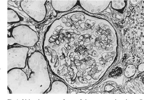 Figure 1 From Uva Dare Digital Academic Repository Delayed Onset Of Membranoproliferative