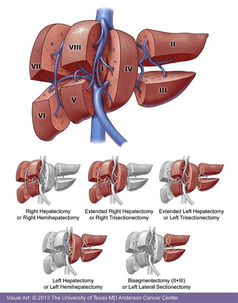 6 Innovative Liver Cancer Treatment Options Md Anderson Cancer Center