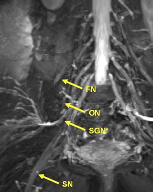 Lumbar Plexus Mri