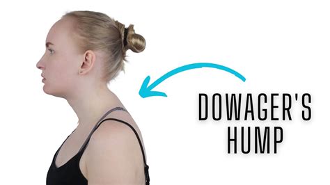 Dowager S Hump 3 Exercises To Reduce The Curve YouTube