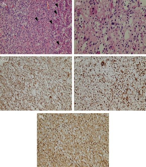 Undifferentiated Embryonal Sarcoma Of The Liver In An Adult Case