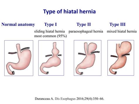 Diagnosis of sliding hiatal hernia | PPT | Free Download